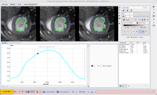In PMOD PCARDM, based on artificial intelligence (AI) segmentation, simplify the analysis of cardiac function.Figure shows the epicardial and endometrium outline, but according to need, easy adjustment.Figure generated in the volume - cardiac cycle curve, function parameters has been drawn into the form.